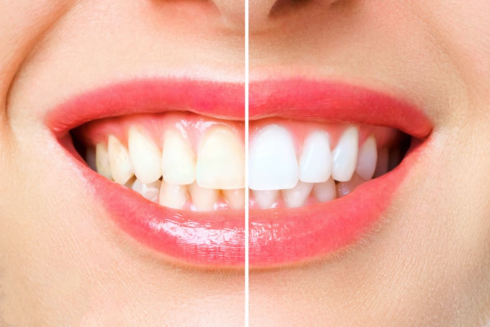 Get teeth whitening at Holy City Dentistry on James Island SC